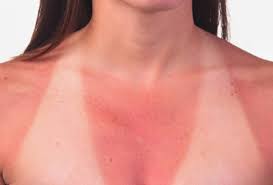 a picture of a woman with badly sunburned skin